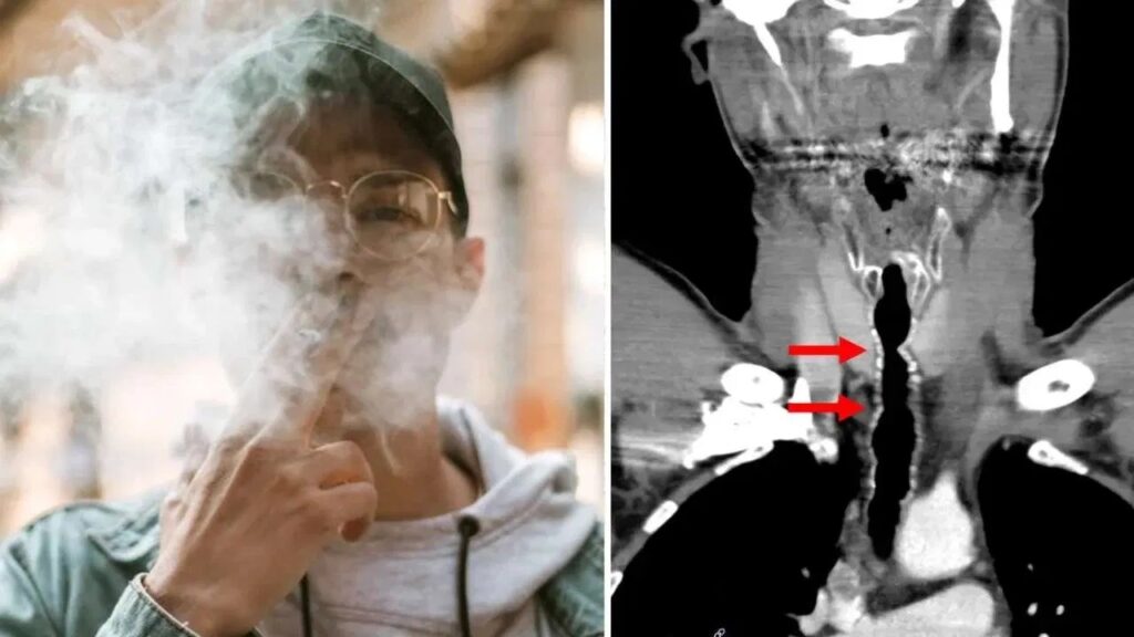 மூச்சுத் திணறலால் மருத்துவமனையில் அனுமதிக்கப்பட்ட ஒருவருக்கு தொண்டைக்குள் முடி வளர்ந்துள்ளது…